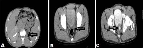 aphallia male|penile agenesis.